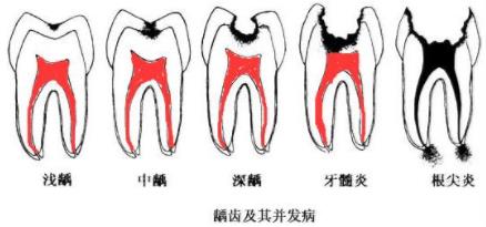 深齲