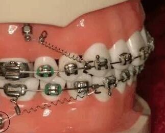 傳(chuan) 統金屬托槽