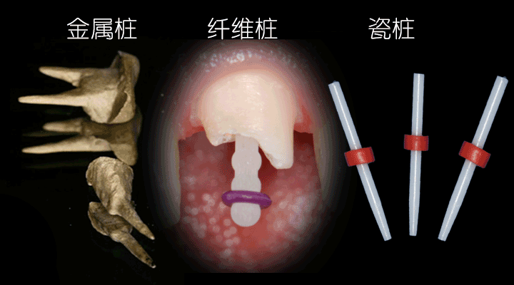 不同的樁核區別