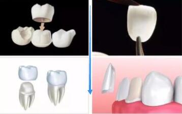 牙冠和貼麵
