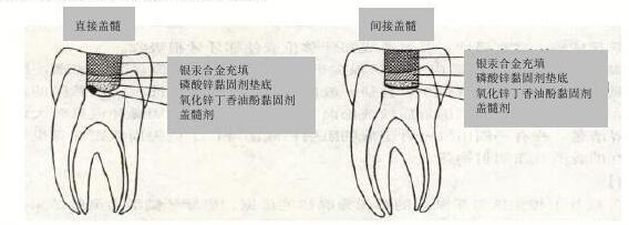 蓋髓治療
