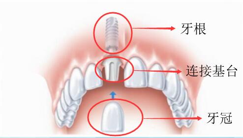種植牙結構