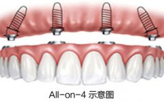 all-on-4種植牙技術目前成熟嗎