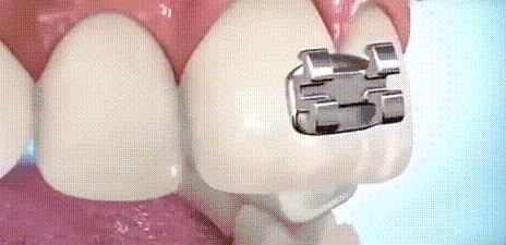 把托槽粘結到合適的位置