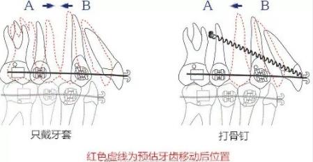 打骨釘和不打骨釘的牙齒移動情況