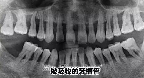 嚴(yan) 重的牙槽骨吸收