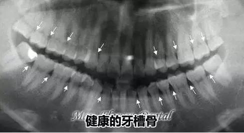 正常的牙槽骨