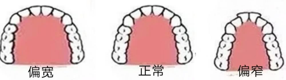 牙弓大小