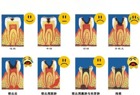 蛀牙以及並發症