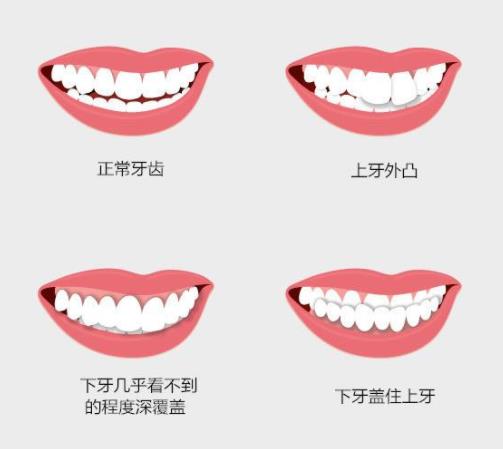 正常牙齒與(yu) 常見牙齒不齊