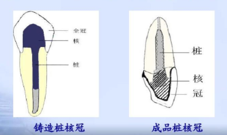 樁核冠示意圖