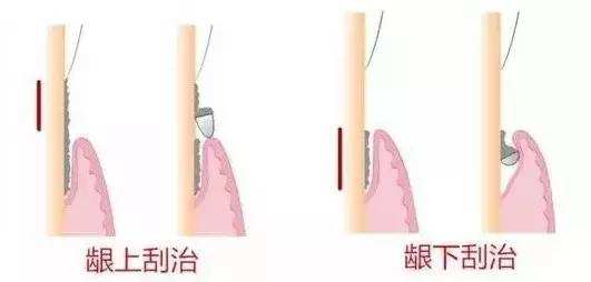 齦上潔治和齦下刮治