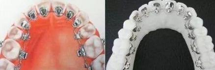 舌側(ce) 托槽矯正