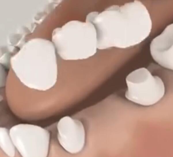 缺牙後牙冠橋修複