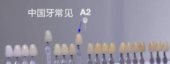 常見牙齒顏色