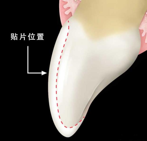 貼麵磨牙