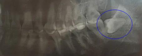 位置不好的智齒