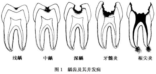 牙齒齲壞程度圖