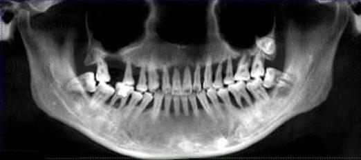 嚴(yan) 重牙周病掉牙的牙齒