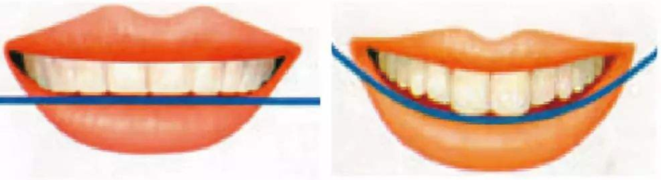牙齒笑線和美觀