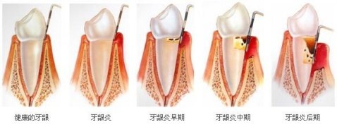 牙齦炎發展