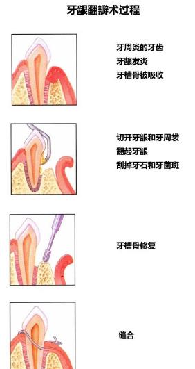牙齦翻瓣手術過程