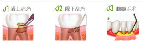 牙周治療方法
