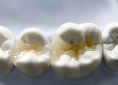 嵌體(ti) 補牙修複