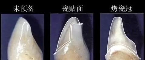 瓷貼麵和烤瓷牙備牙量**圖