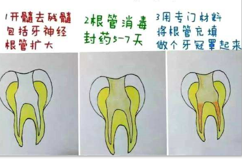 根管治療的大致過程