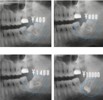 智齒拔牙價(jia) 格參考