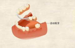 安裝活動假牙後可以換成種植牙嗎
