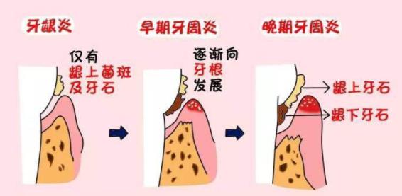 牙周炎發展