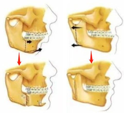 正頜手術示意圖