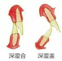 深覆合與(yu) 深覆蓋的區別