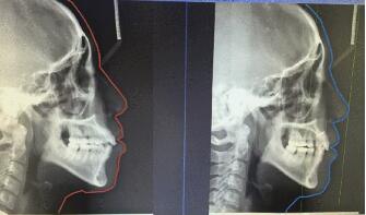 頭顱側(ce) 位片
