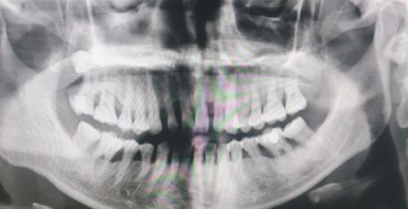 牙周病嚴(yan) 重