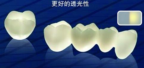 全瓷牙美觀性好