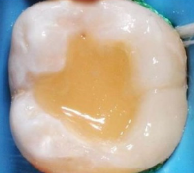 樹脂補牙
