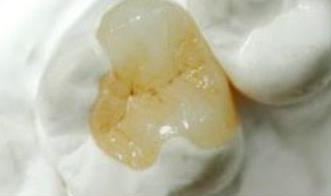 嵌體(ti) 補牙