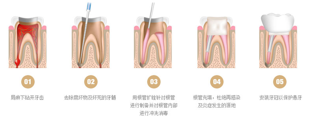 根管治療