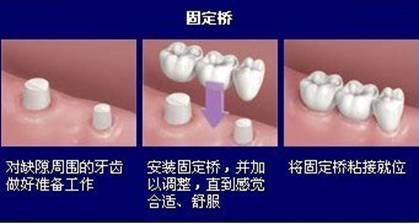 固定橋修複