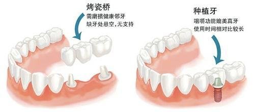 牙齒缺失後種牙和烤瓷牙的區別