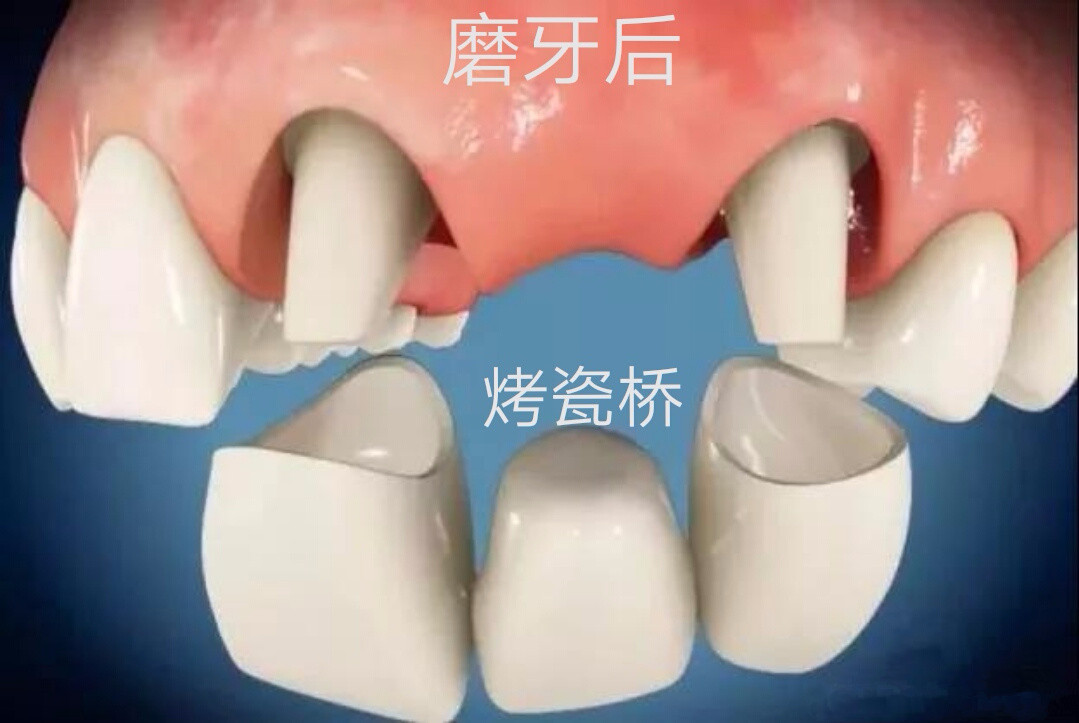 烤瓷橋