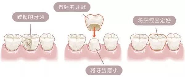 牙齒缺損做牙冠