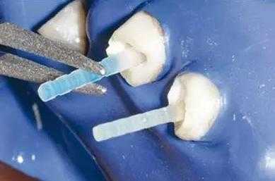 根管治療後打樁