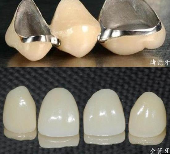 金屬烤瓷牙和全瓷牙