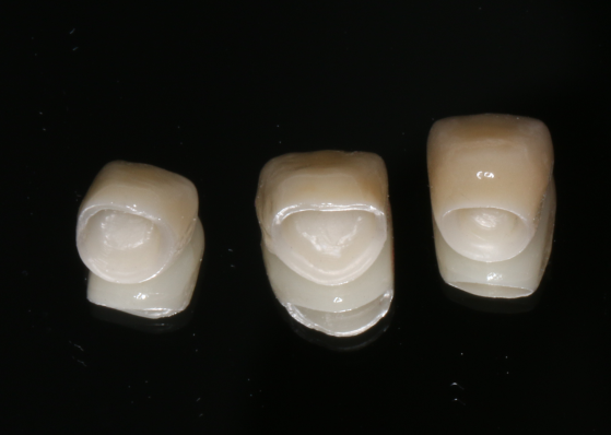 全瓷牙冠
