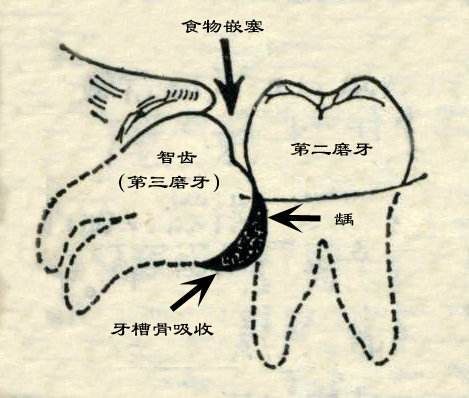 智齒的危害