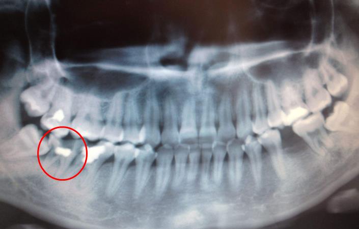 智齒把鄰牙齲壞